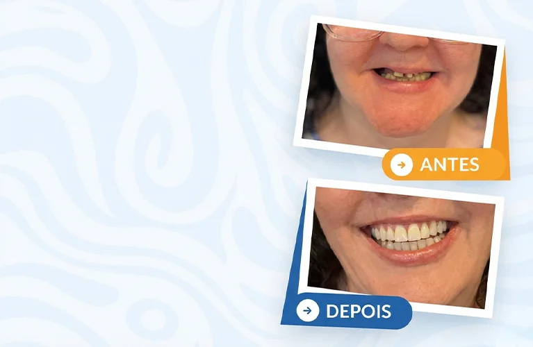 Implantes dentários para substituição de dentes ausentes com segurança e precisão.