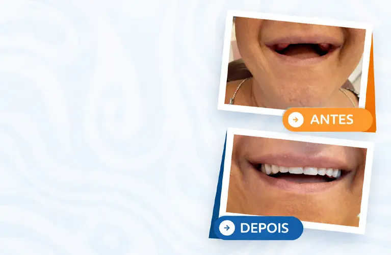 Reabilitação oral com próteses dentárias para devolver função e estética ao sorriso.